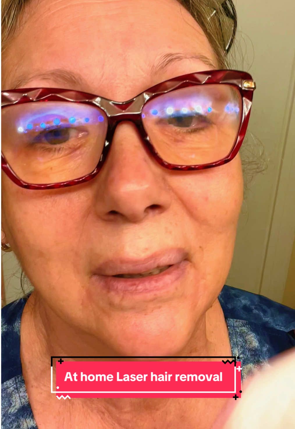 TikTok post by @emiliaskincare for RIKI LOVES RIKI. Caption reads: #laserhairremoval #facialhairremoval....