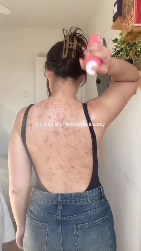 Instagram post by @selflove_aida for dermalogica. Caption reads: Got acne? You NEED to try this spray! I’ve been....