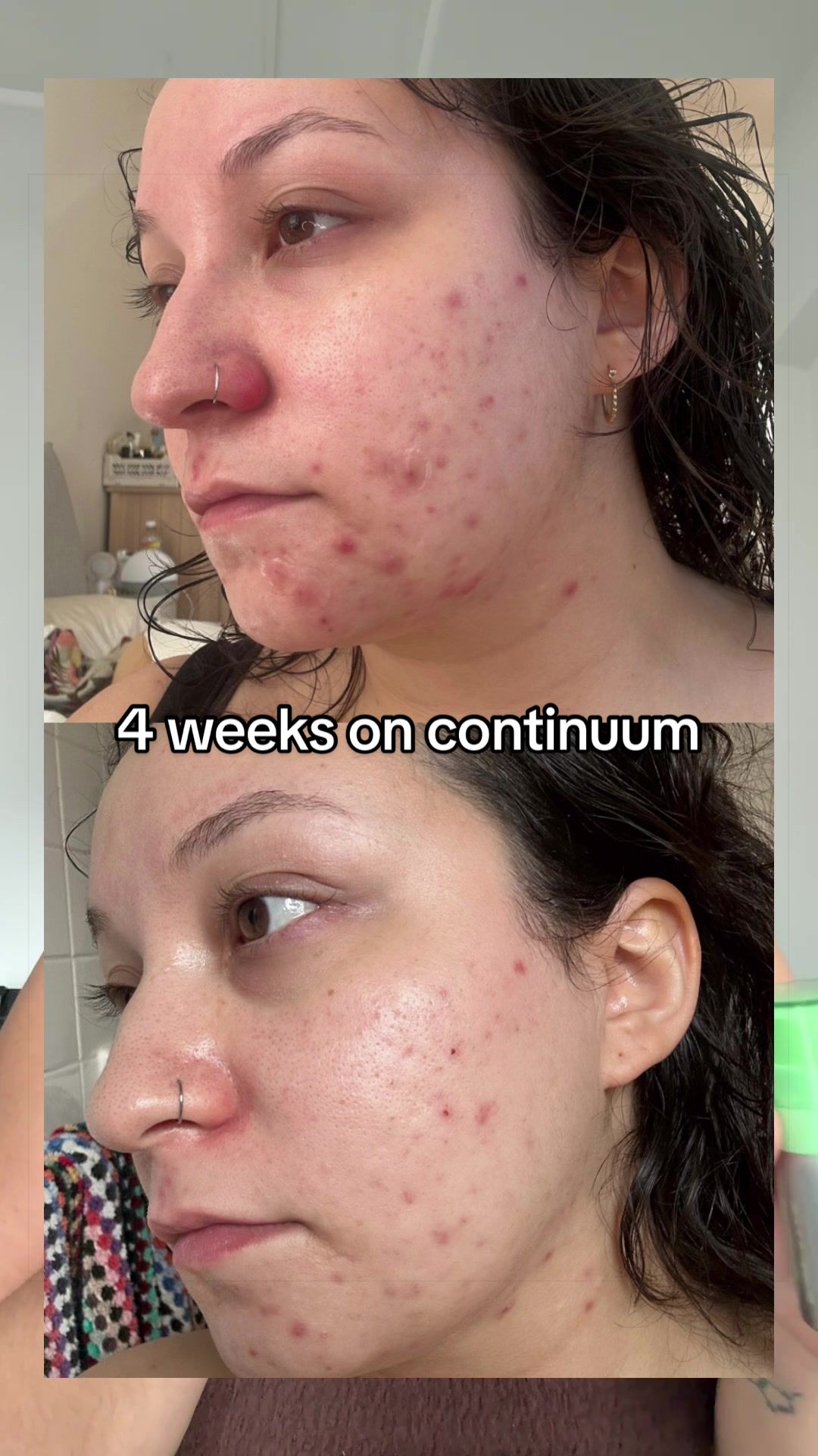 TikTok post by @lisagrrera for Experiment Beauty. Caption reads: [...] and clearer 🥹💚 #beforeandafter....