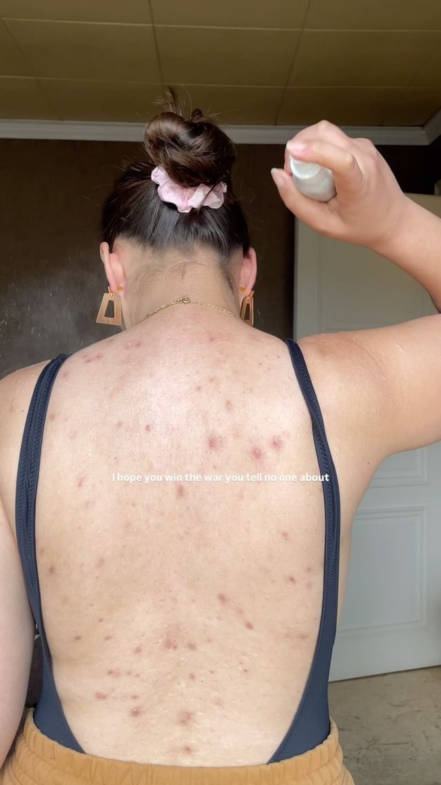 Instagram post by @selflove_aida for Facetheory. Caption reads: I’ve been hiding my body acne since I was eleven.....