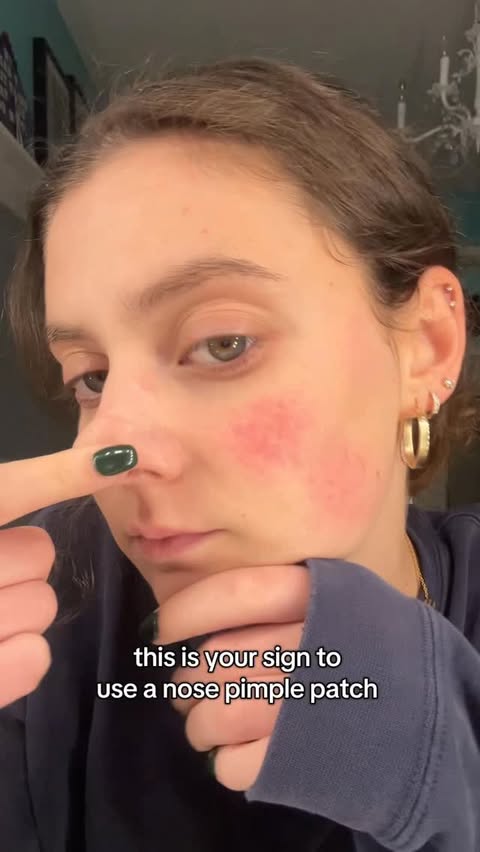 Instagram post by @julesdell_ for Hero Cosmetics. Caption reads: this worked so well omg #nosepatch #pimplepatch....