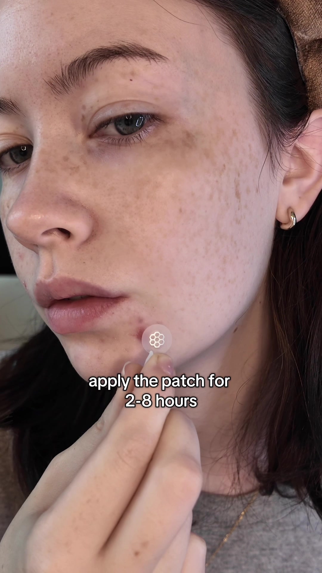 TikTok post by @kaydlim for Easyderm Vietnam. Caption reads: time to worry less about your acne with @Easyderm....