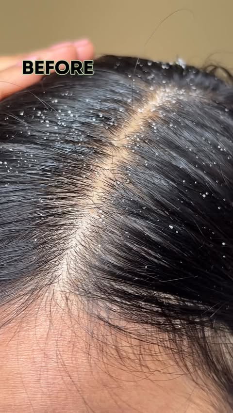 Instagram post by @ismaranikaganguly for Bare Anatomy. Caption reads: [...] the cost of my scalp 😌 Switched to Bare....