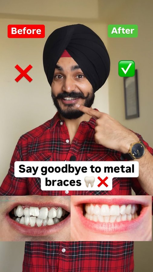 Instagram post by @santwinder_singh_waraich for toothsi by makeO. Caption reads: #ad Say goodbye to metal braces and hello to a....