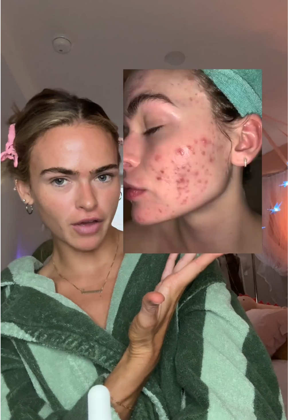 TikTok post by @summermckeen for Pacifica Beauty. Caption reads: Some things I learned from having acne🤓☝🏼....