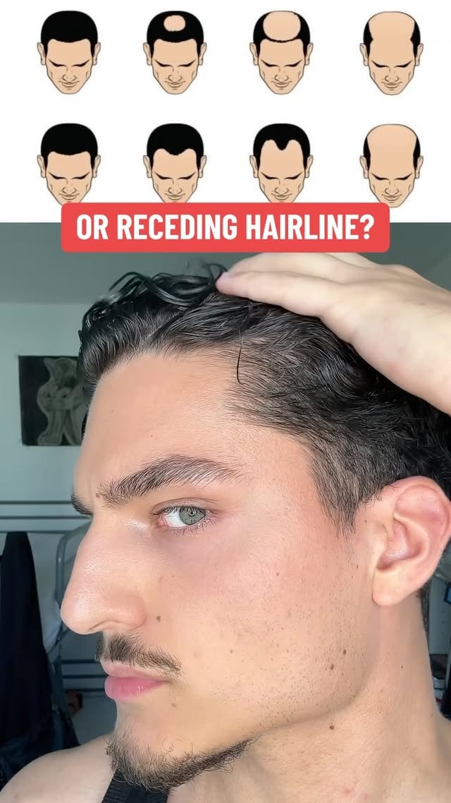 Instagram post by @adixovic for Douxds. Caption reads: [...] pattern baldness with RIZE tutorial @douxds....