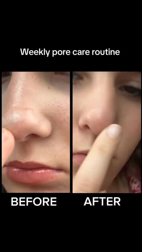 Instagram post by @addison.apgar for ilso. Caption reads: [...] solution for gently removing blackheads....
