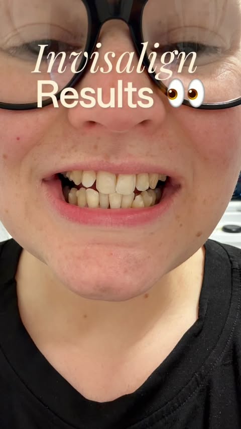 Instagram post by @symone.loves for Invisalign. Caption reads: Invisalign results !!! If you have been on the....