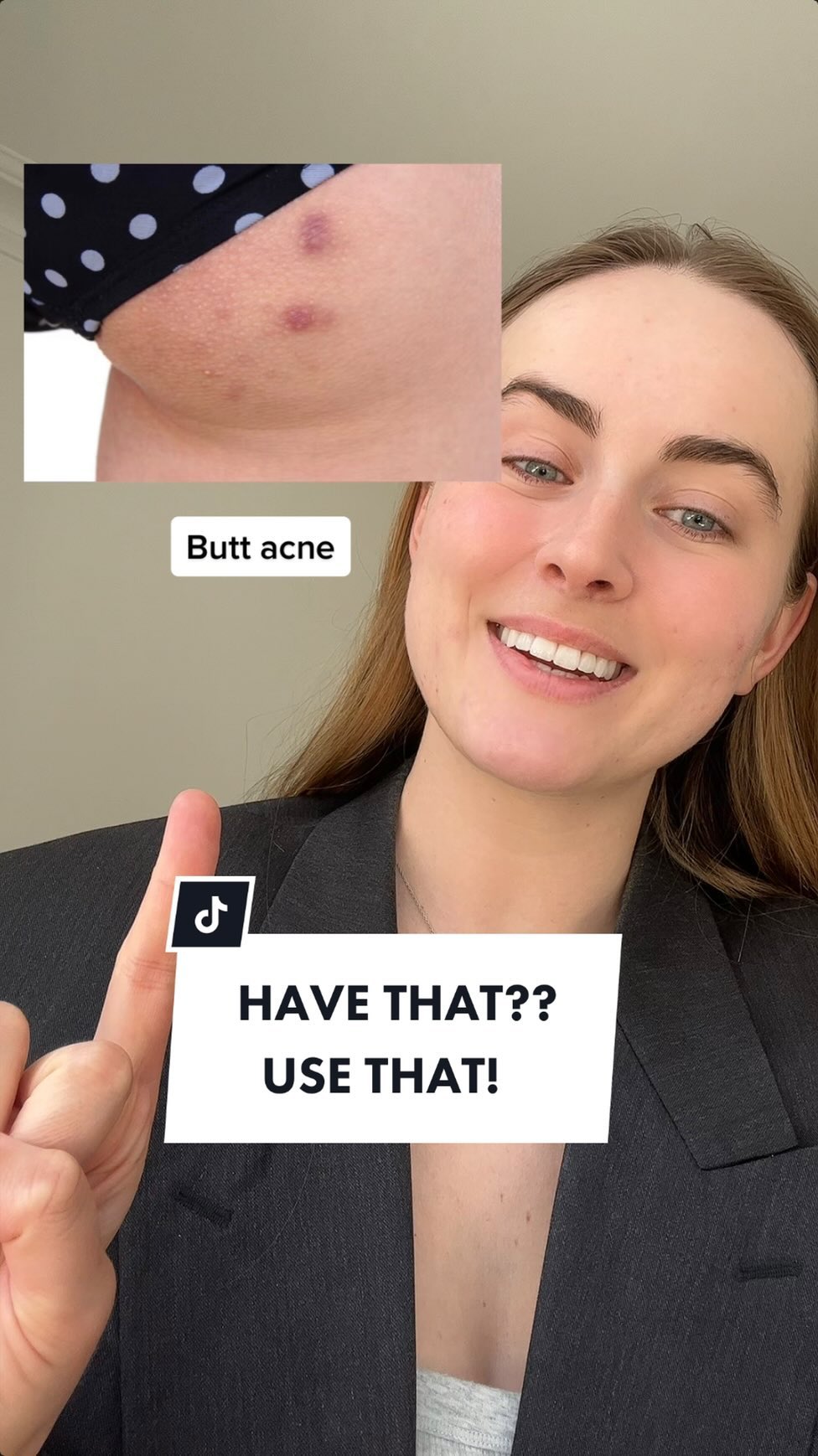 Instagram post by @carolinehannibal for Australian Bodycare. Caption reads: Here’s how to treat your body & butt acne....