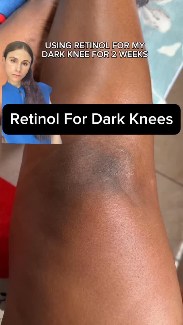 Instagram post by @drdrayzday for Gold Bond. Caption reads: Can retinol lighten dark knees? #darkknee....