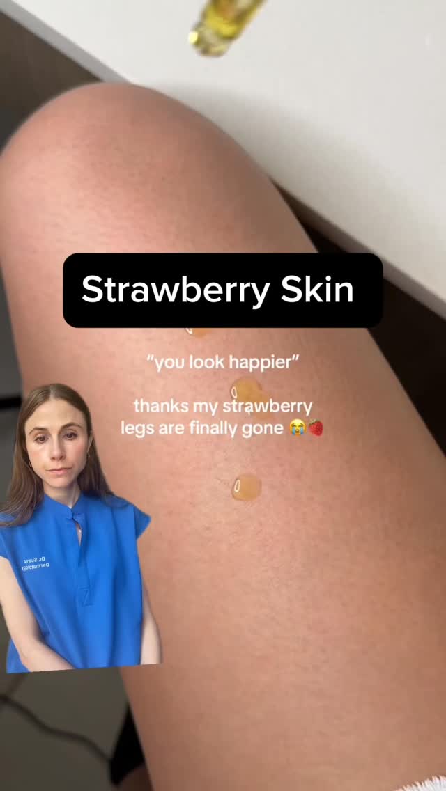 Instagram post by @drdrayzday for Gold Bond. Caption reads: How to get rid of strawberry skin once and for....