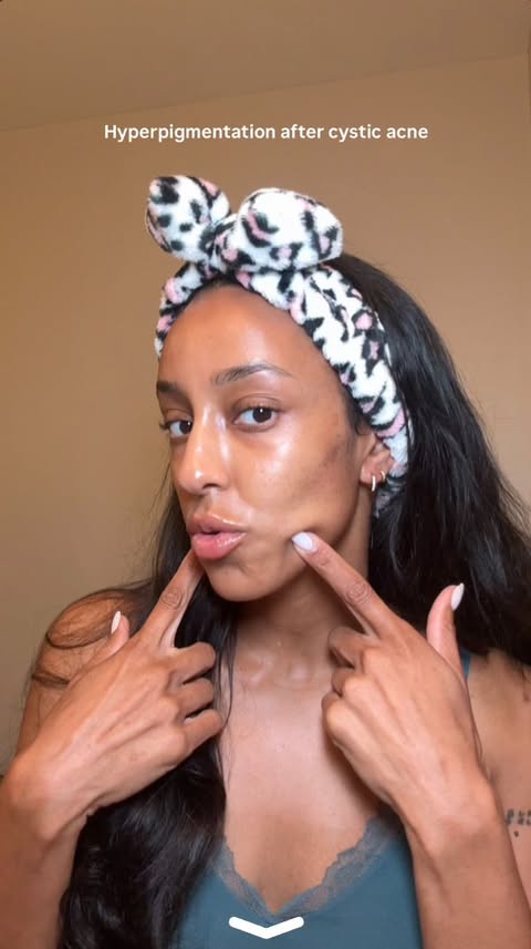 Instagram post by @lulaindee for Curology. Caption reads: #CurologyPartner Getting cystic acne in my late....