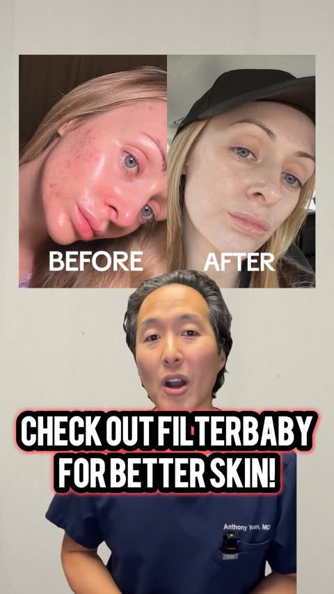 Instagram post by @tonyyounmd for Filterbaby. Caption reads: [...] discount code and link to the website....