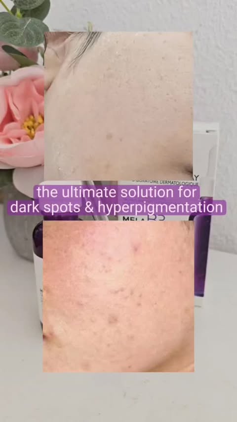 Instagram post by @nerdyhead99 for La Roche-Posay. Caption reads: [...] dark spots and hyperpigmentation La....
