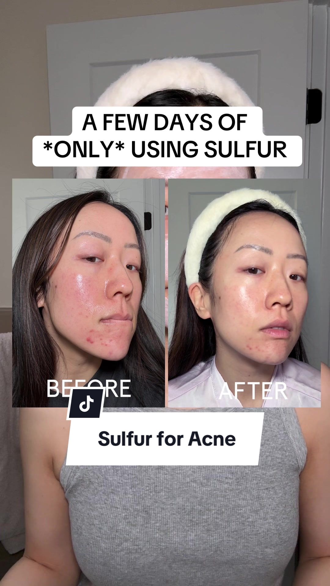 TikTok post by @annietamaki for Kate Somerville. Caption reads: [...] of my favorite sulfur products, the @Kate....