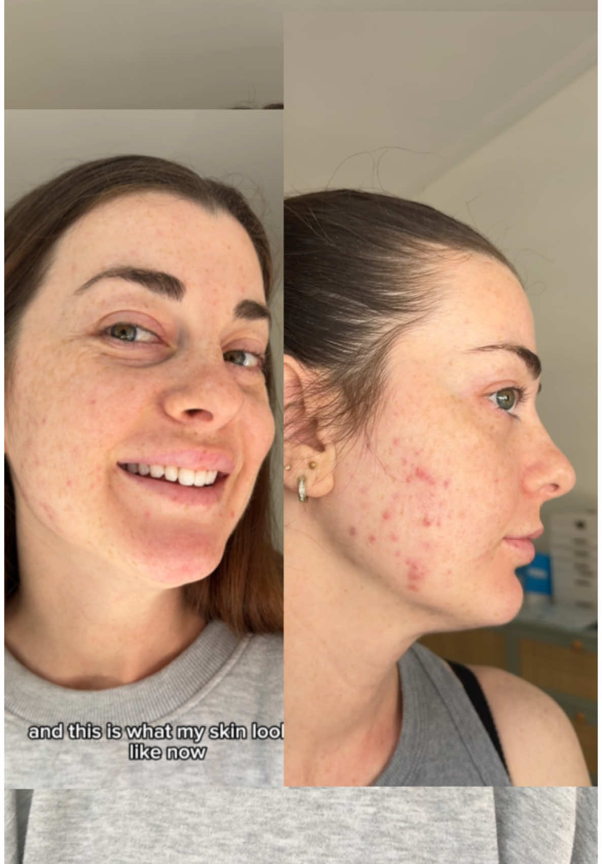 TikTok post by @daniellewalter_ for currentbody. Caption reads: my acne healing secret @currentbody....
