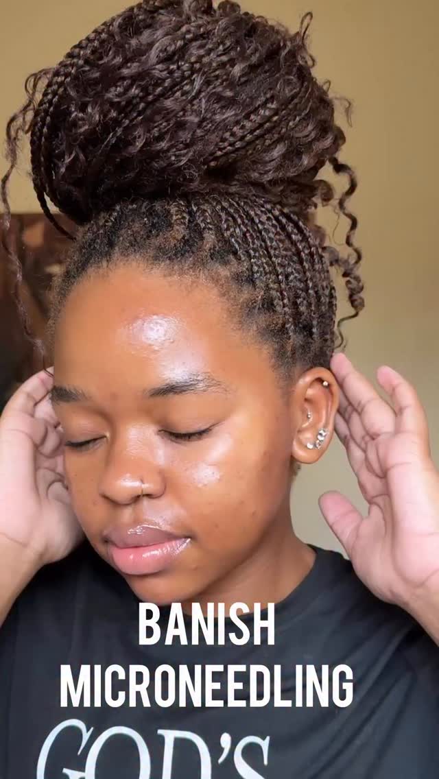 Instagram post by @oratilemororo for Banish. Caption reads: 3 months using the @banishacnescars @banish....