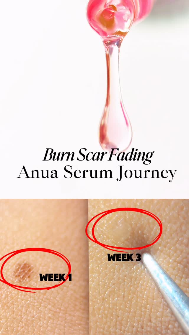 Instagram post by @bioglamcare for Anua. Caption reads: Burn Scar Fading: Anua Serum Journey

Just wanted....