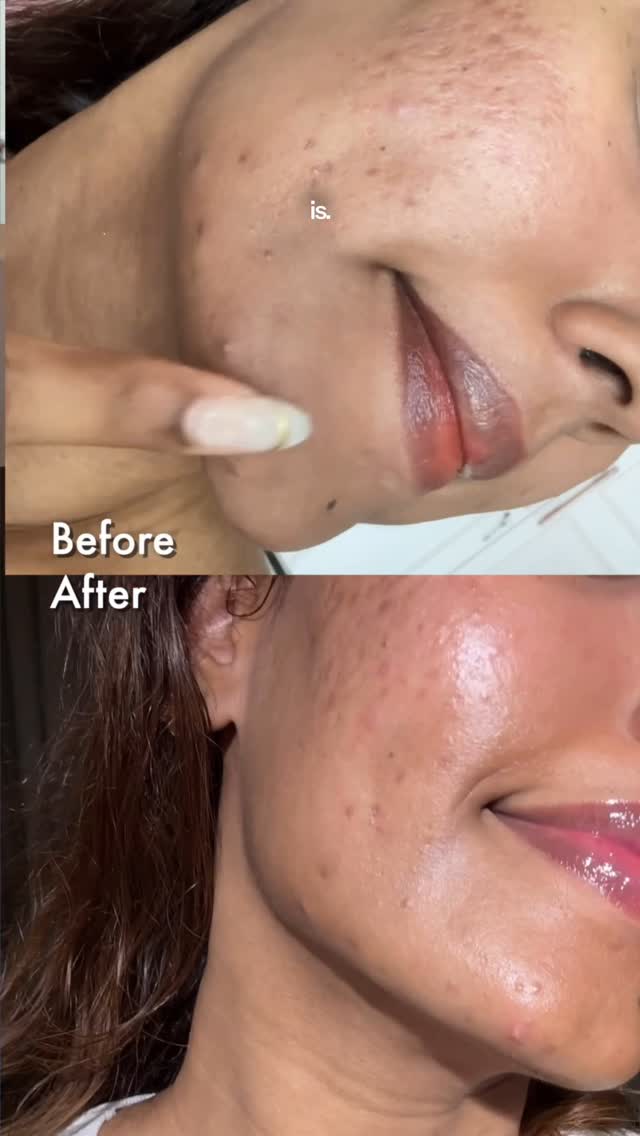 Instagram post by @sarahsaroshh for Foxtale. Caption reads: Post Eid Sugar spikes come with their pimple....