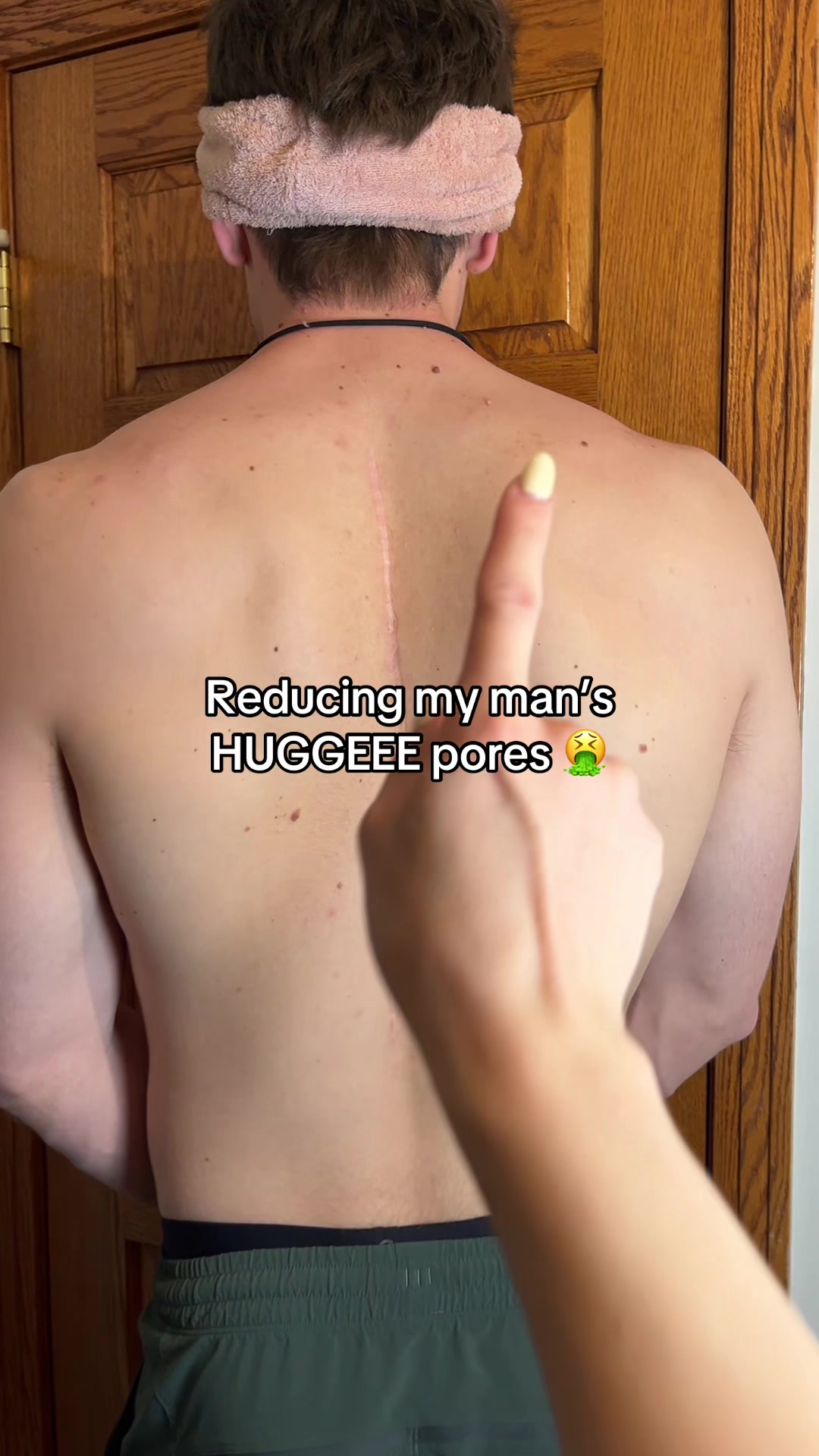 TikTok post by @ryryfindss for Skintific. Caption reads: [...] #acne #largepores @SKINTIFIC US Store.