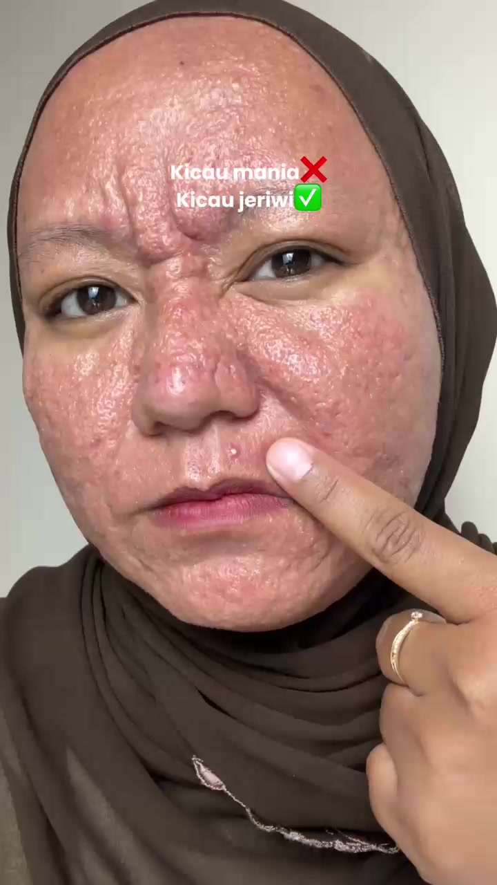TikTok post by @rikawdwt21 for Nurilab.id. Caption reads: [...] cuma pake acne conclearingnya @Nurilab.id....