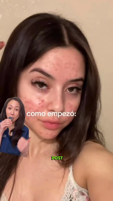 Instagram post by @derm.talk for Anua. Caption reads: [...] acne marks and uneven skin tone? #ad....