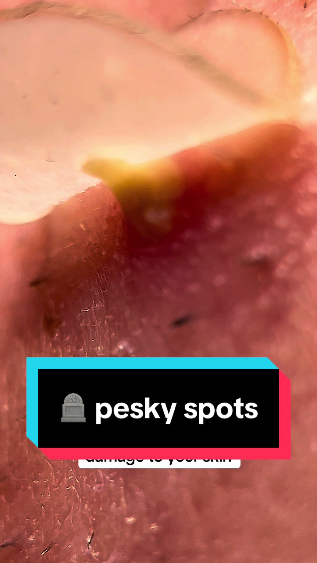 TikTok post by @johnny2k123 for PurePatch. Caption reads: @PurePatch 🪦💀 to all those pesky spots on my....