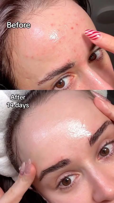Instagram post by @thelipstickgirly for Easydew. Caption reads: 14 days skin transformation ☺️ @easydew_usa....
