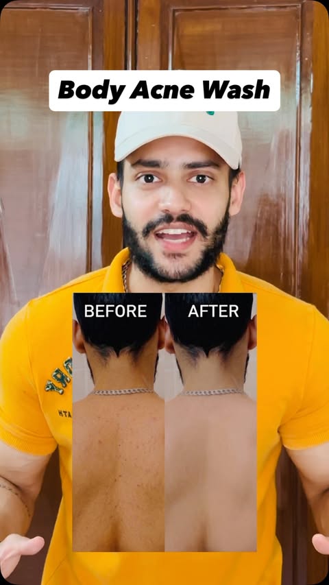 Instagram post by @mridulkumaar for Foxtale. Caption reads: Body acne? Not on my watch. Been using....
