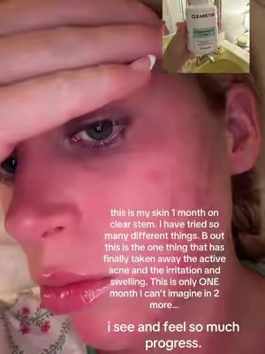 TikTok post by @cammietimm for CLEARSTEM Skincare. Caption reads: [...] But finally gaining some hope! @CLEARSTEM....