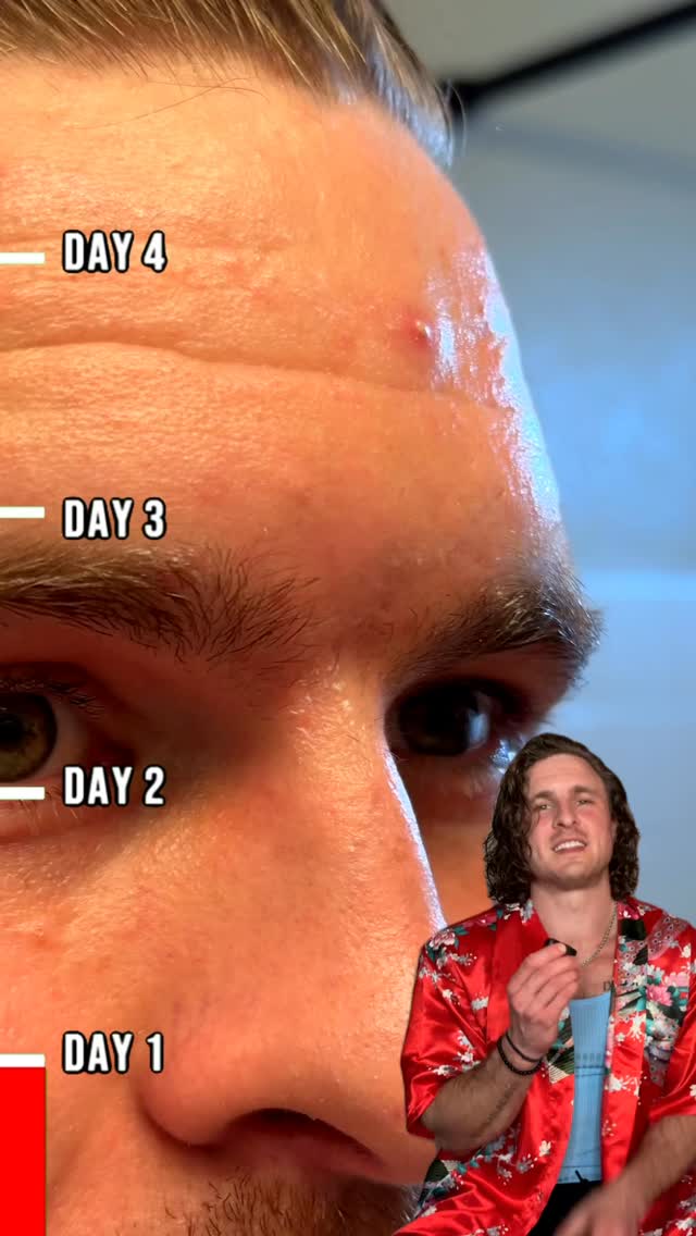 Instagram post by @teamacne for Banish. Caption reads: POV: you DON’T pop a pimple 😮😅 Could....