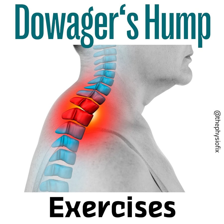 Instagram post by @thephysiofix for Senita Athletics. Caption reads: ⁉️Do you have a neck hump? 🦬😫 Want some....