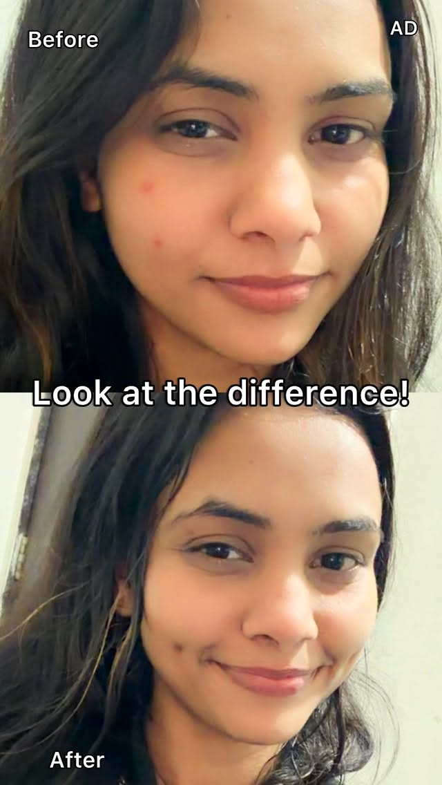 Instagram post by @its_shivani_queen for Clean & Clear. Caption reads: Big or small, meltdowns have one common enemy:....