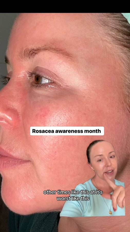 Instagram post by @thebeautybloss for Amperna. Caption reads: ad Got a question about rosacea?

Rosacea can....