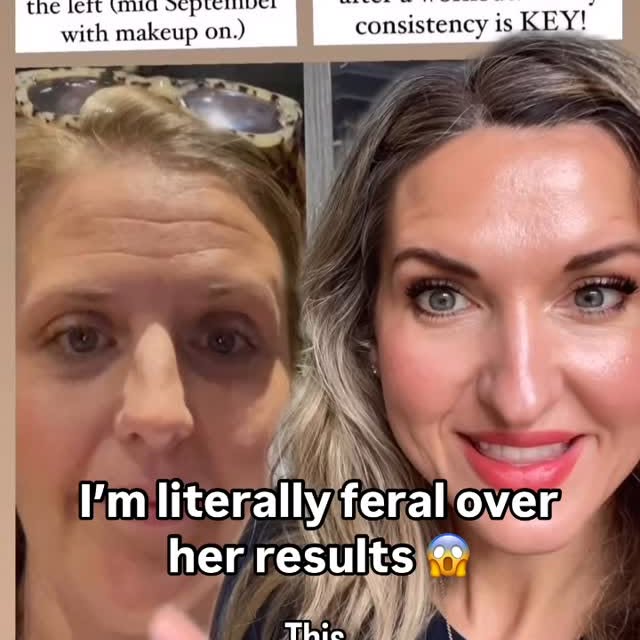 Instagram post by @helenkmorrison for FROWNIES. Caption reads: [...] No injectibles. No filters. Just Frownies.....