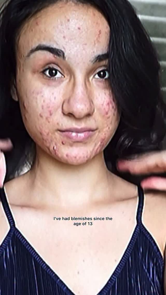 Instagram post by @its_just_acne for Theinkeylist. Caption reads: I’ve had blemishes since the age of 13. I’ve....