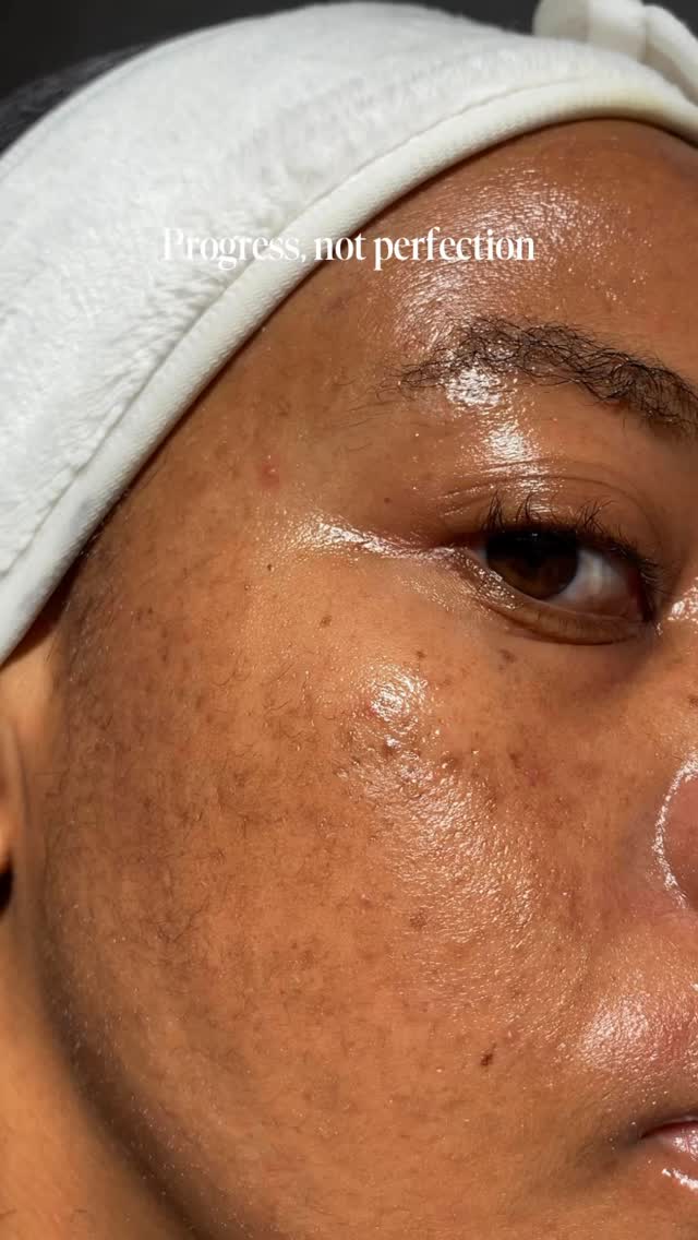 Instagram post by @simphiwee_mb for Banish. Caption reads: [...] My skin has come such a long way with....