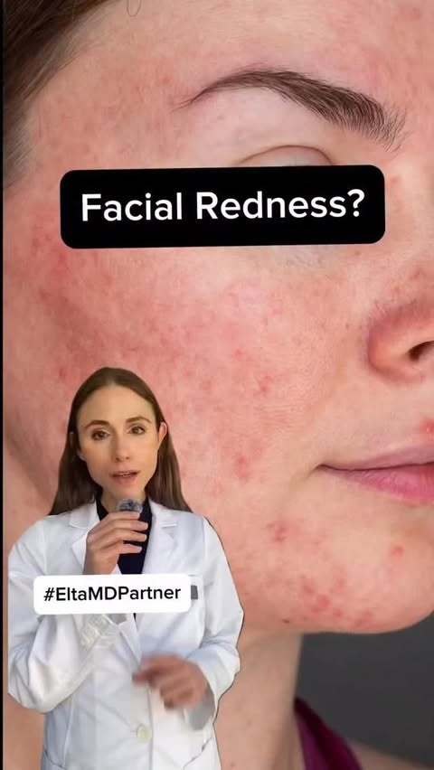 Instagram post by @drdrayzday for EltaMD. Caption reads: #EltaMDPartner Struggling with facial redness?....