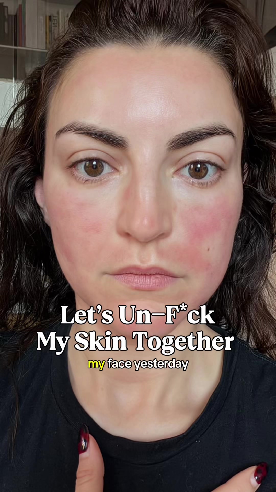 TikTok post by @charlotteparler for Dieuxskin. Caption reads: I love microneedling… but it didn’t love me (right....