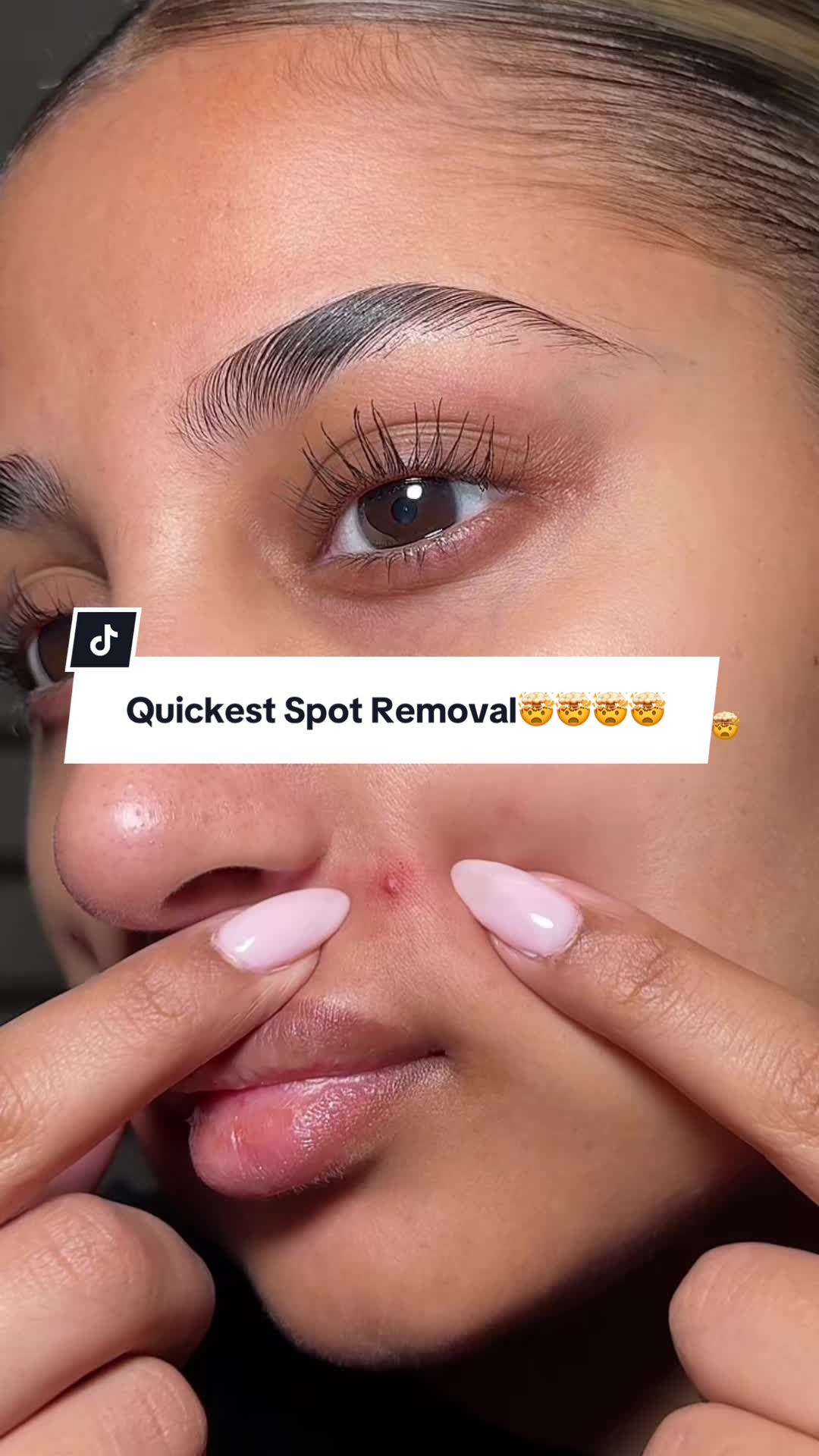 TikTok post by @lailapaul7 for Easyderm Vietnam. Caption reads: The fastest way to calm my pimples with @Easyderm....