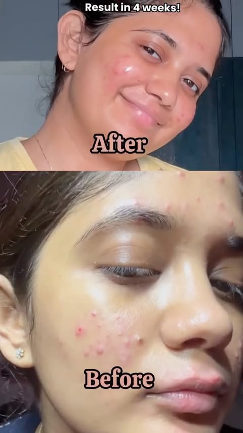 Instagram post by @trishaaraj_ for Juicy Chemistry. Caption reads: [...] 🔗 Acne-prone skin girlies, this Juicy....