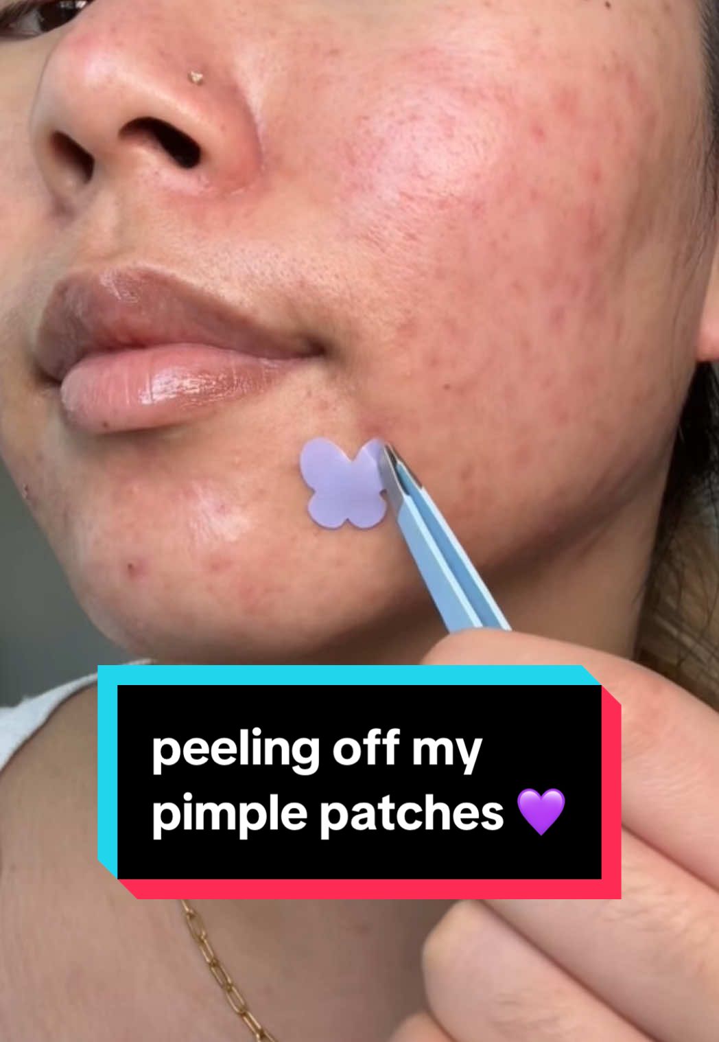 TikTok post by @dewylouie for florence by mills. Caption reads: [...] how well these patches work 🦋☁️💜 @florence....