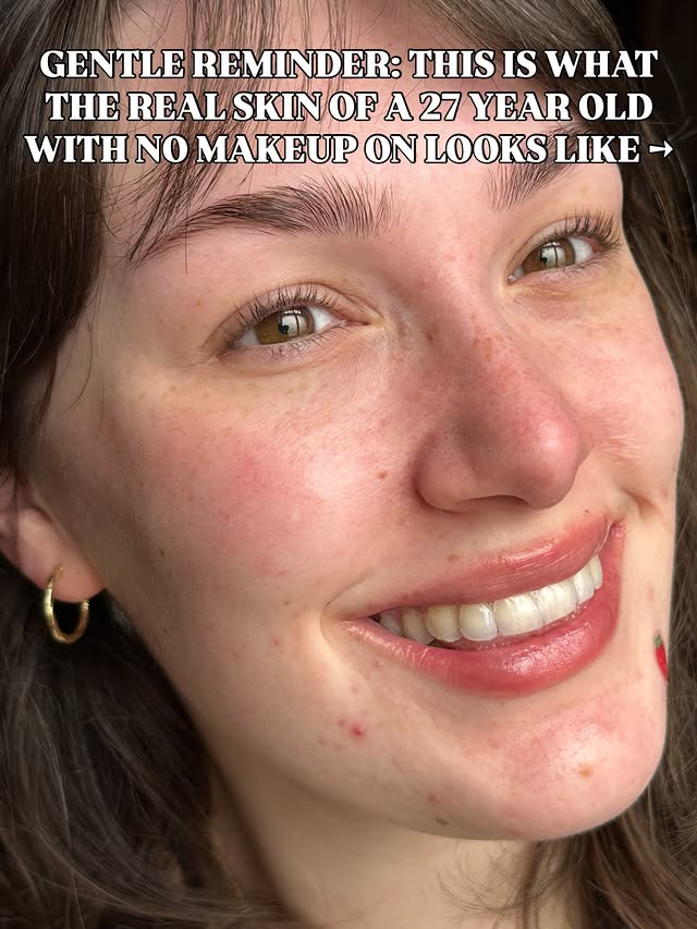 Instagram post by @emmajditto for Dove. Caption reads: [...] ❤️‍🩹 #realskin #realbeauty #facialscars....