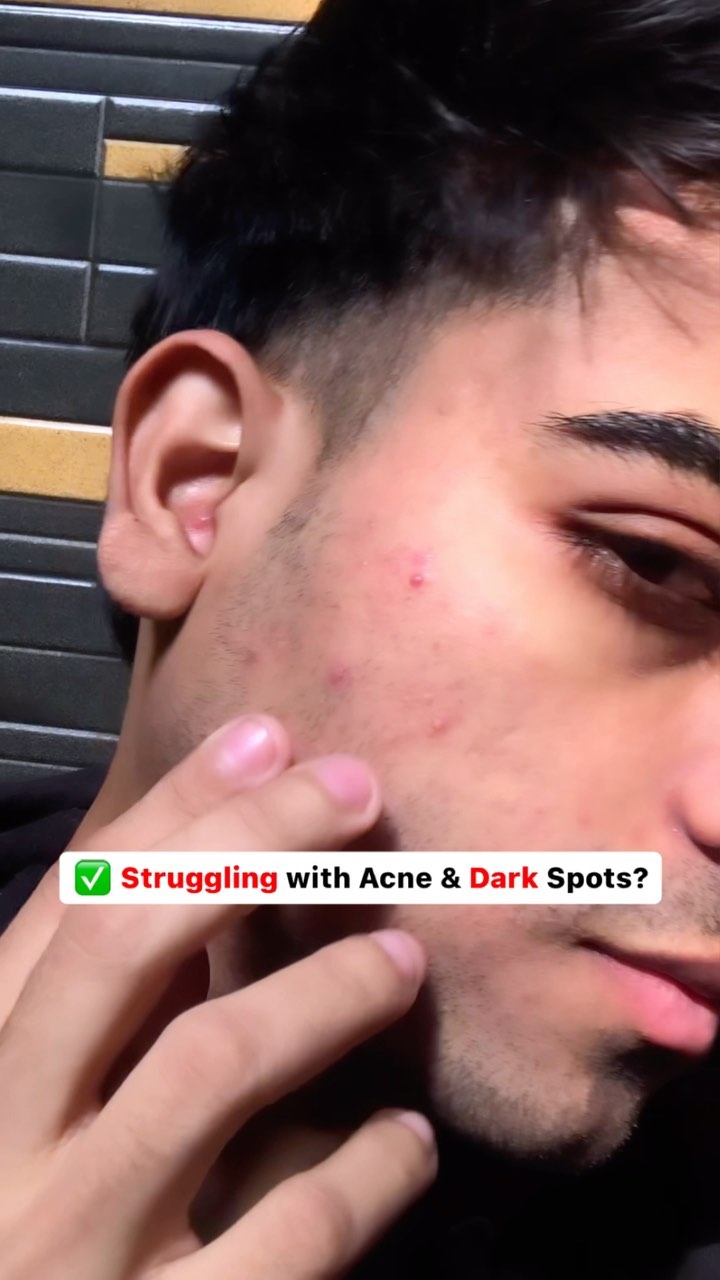 Instagram post by @viratsinghh.08 for The Ayurveda Co.. Caption reads: ✅ Say goodbye to acne & spots!  ad

@theayurvedaco....