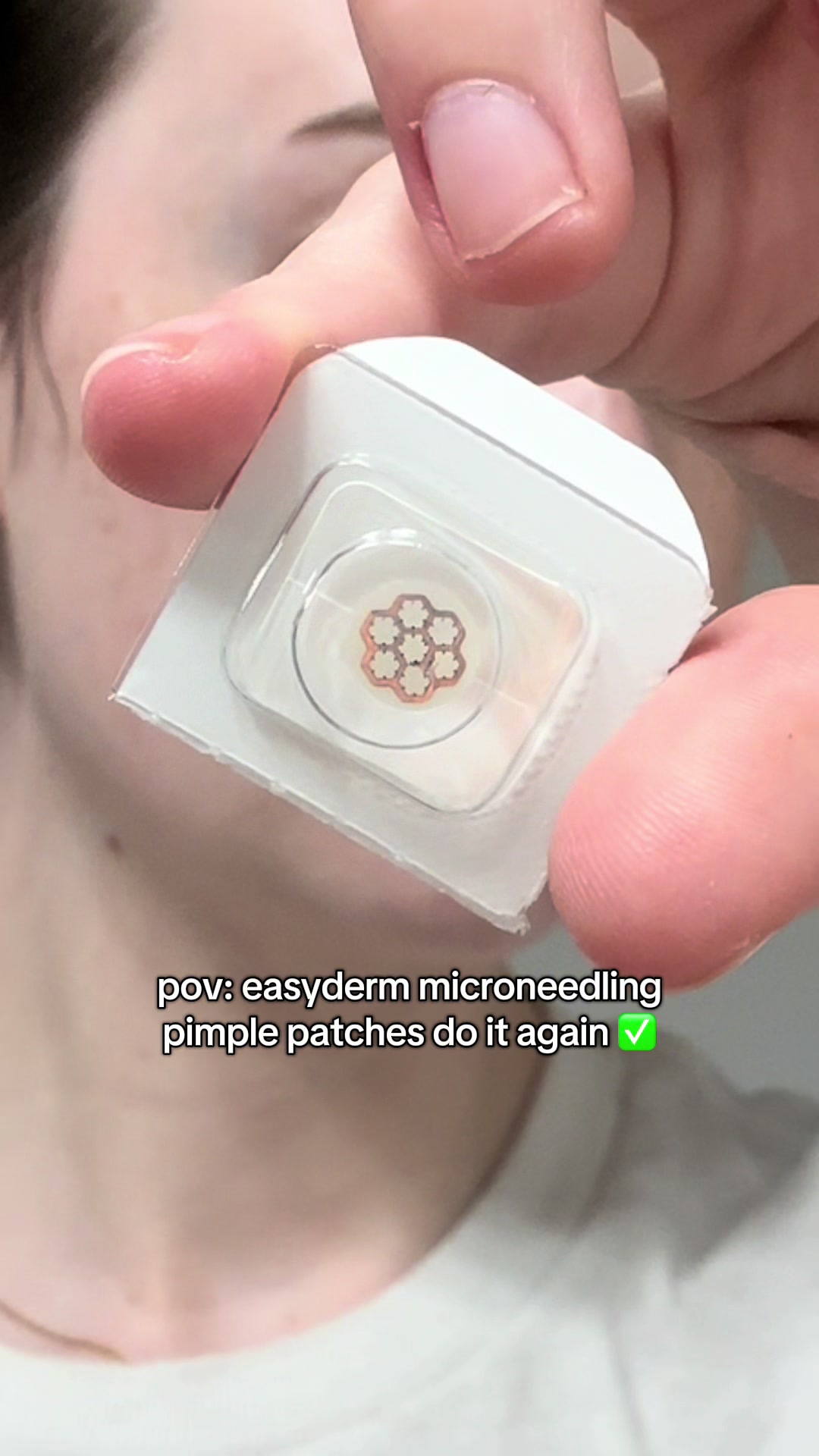TikTok post by @kaydlim for Easyderm Vietnam. Caption reads: from inflamed and irritated acne, to dried down....
