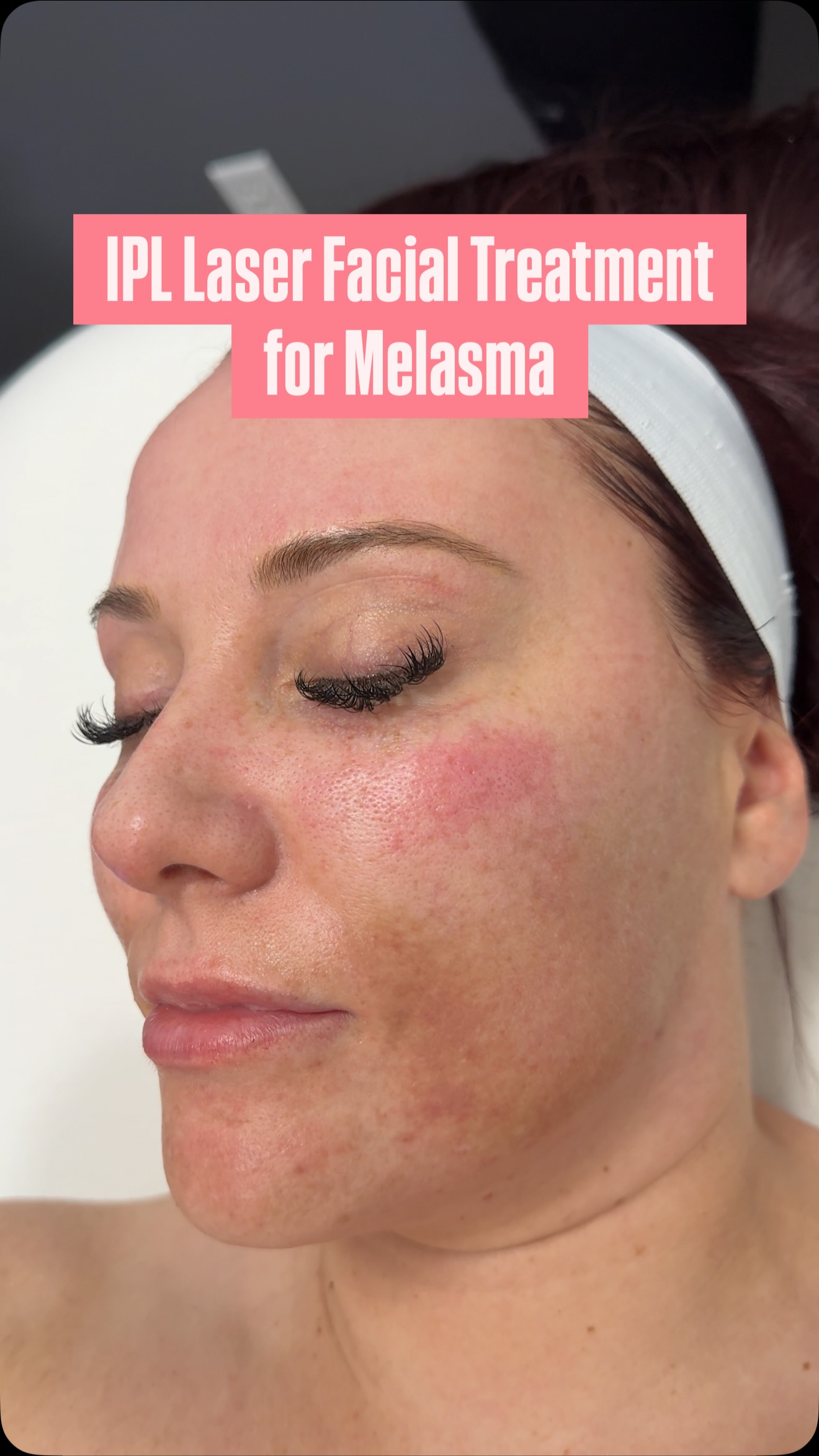 Instagram post by @aubrey_red_ for LaserAway. Caption reads: ✨ IPL Laser Facial at @LaserAway ✨
I’ve struggled....