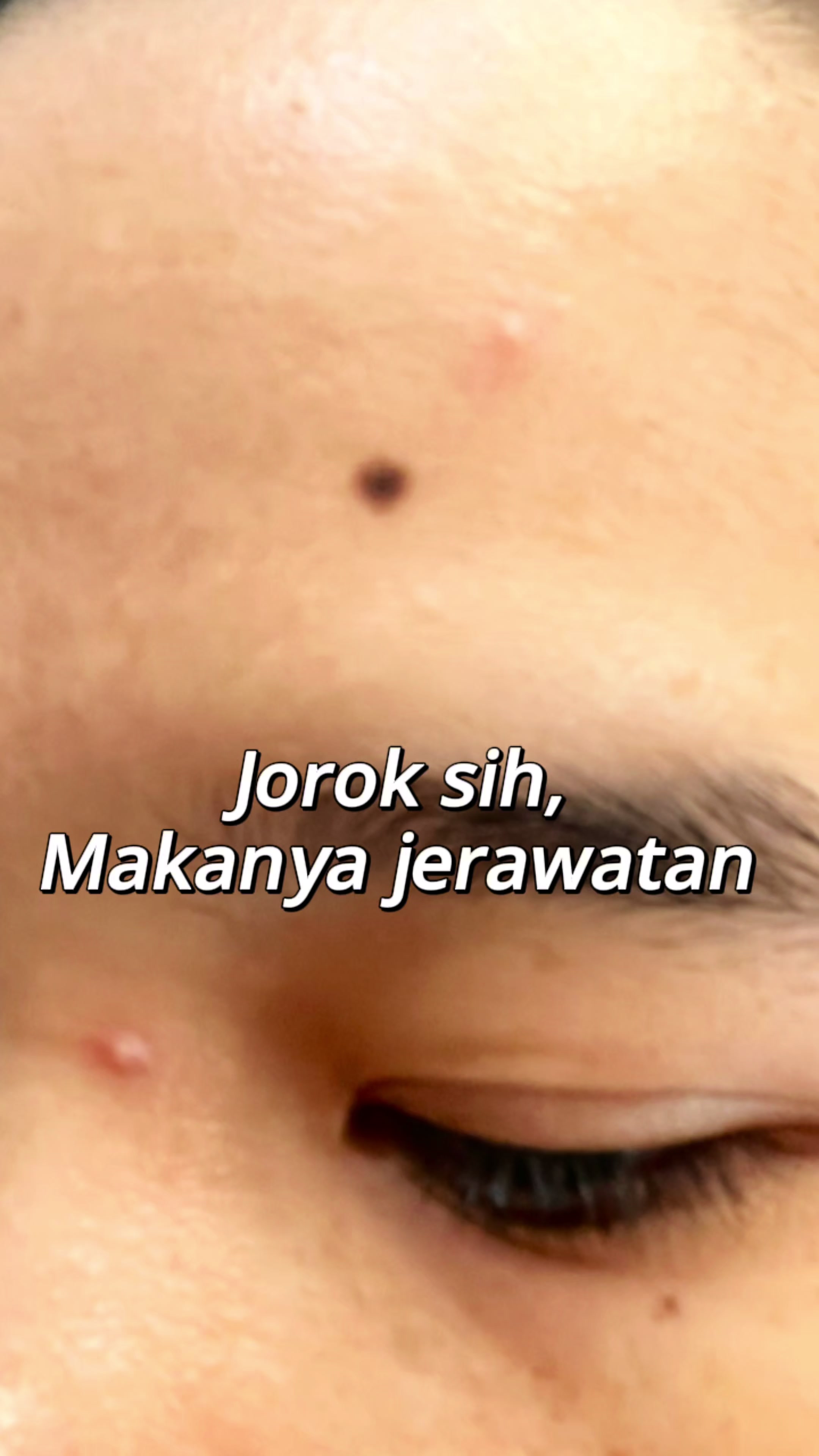 TikTok post by @ameliaflorentinesiburian for Acneno Indonesia. Caption reads: [...] acne fighter terus semangat ya.. @Acneno....