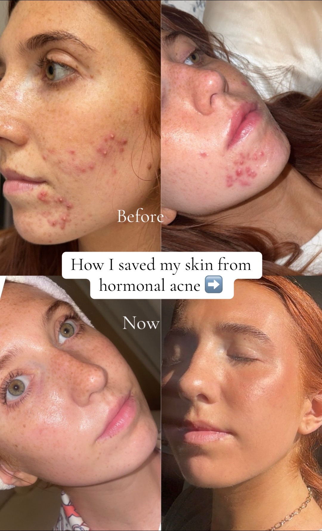 TikTok post by @alliewesty for Face Reality. Caption reads: I had perfect skin for years until this happened....