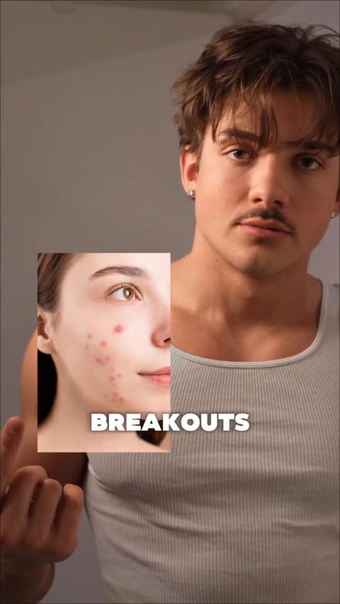 Instagram post by @elijah.forcier for APRILSKIN. Caption reads: stop popping your acne do this....