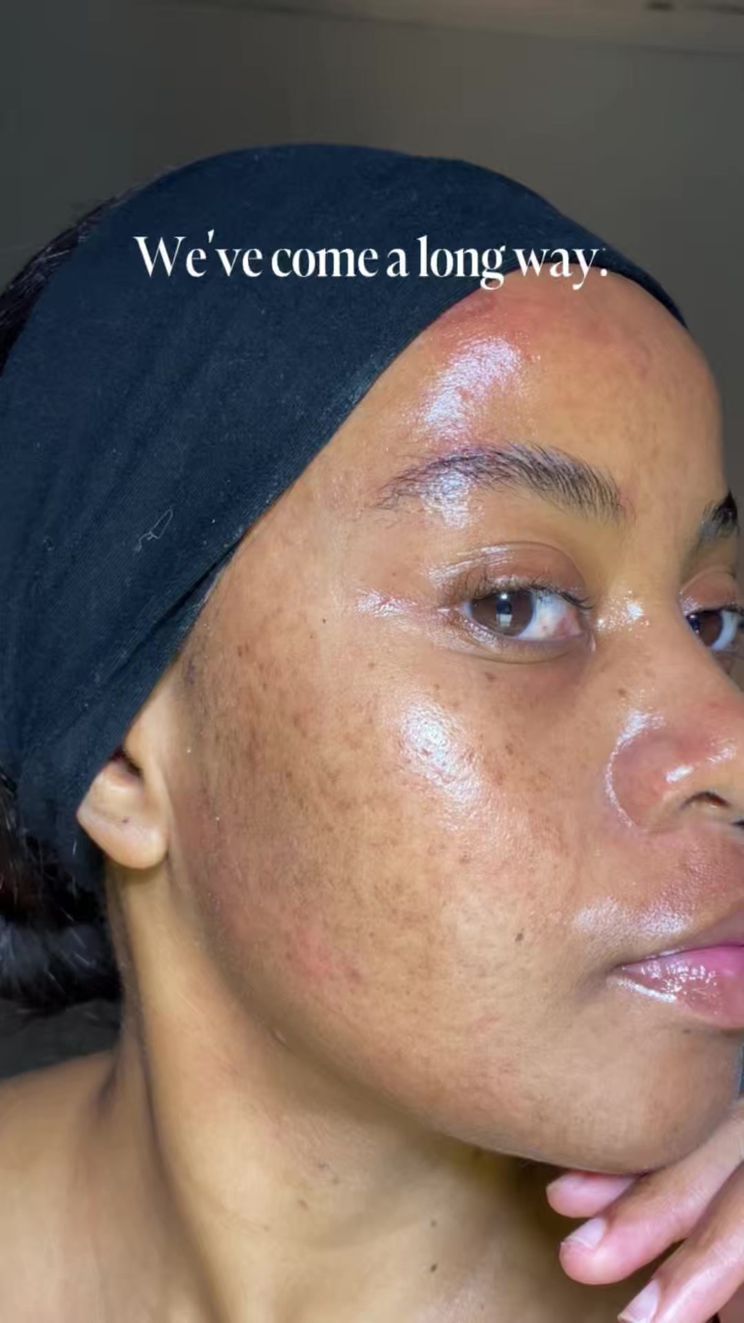 TikTok post by @simphiwee_mb for Banish. Caption reads: [...] it felt slow. Look at you now… #skin....